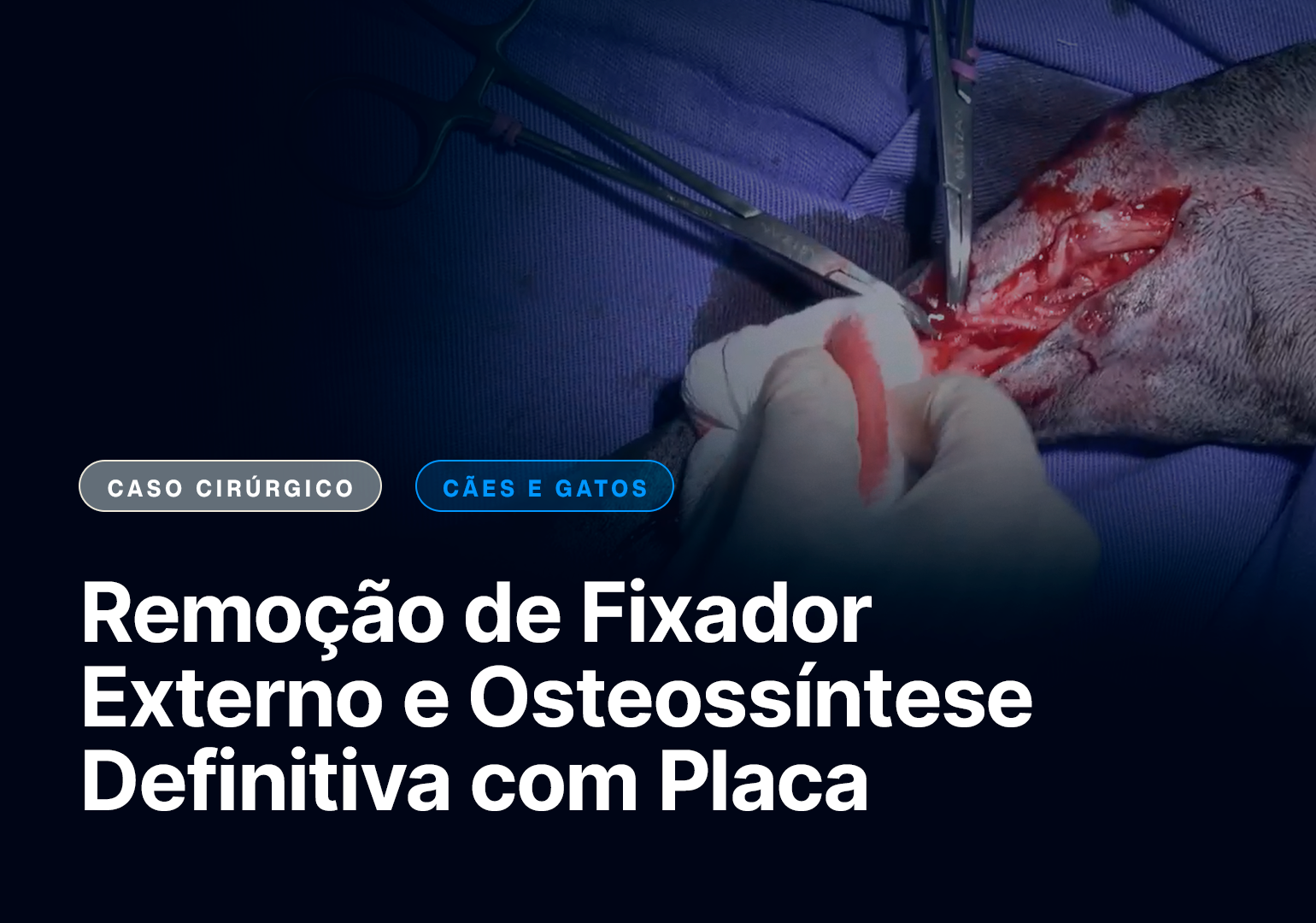 Remoção de Fixador Externo e Osteossíntese Definitiva com Placa